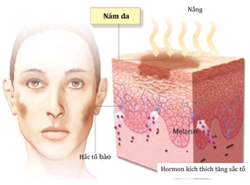 Cà rốt trị nám da
