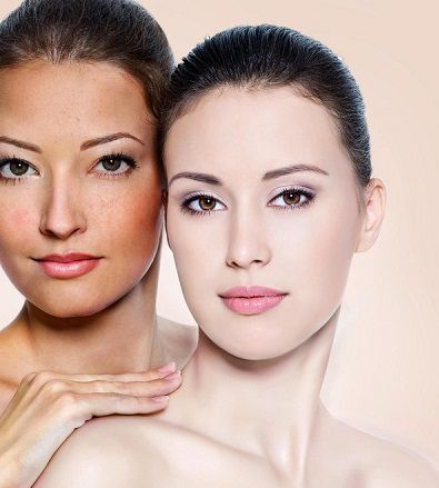 Cách trị nám da hiệu quả nhất