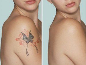 Xóa hình xăm giá bao nhiêu tiền