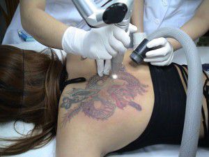xóa xăm ở đâu uy tín