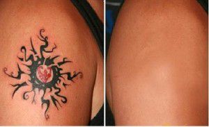 Xóa xăm ở đâu tốt nhất