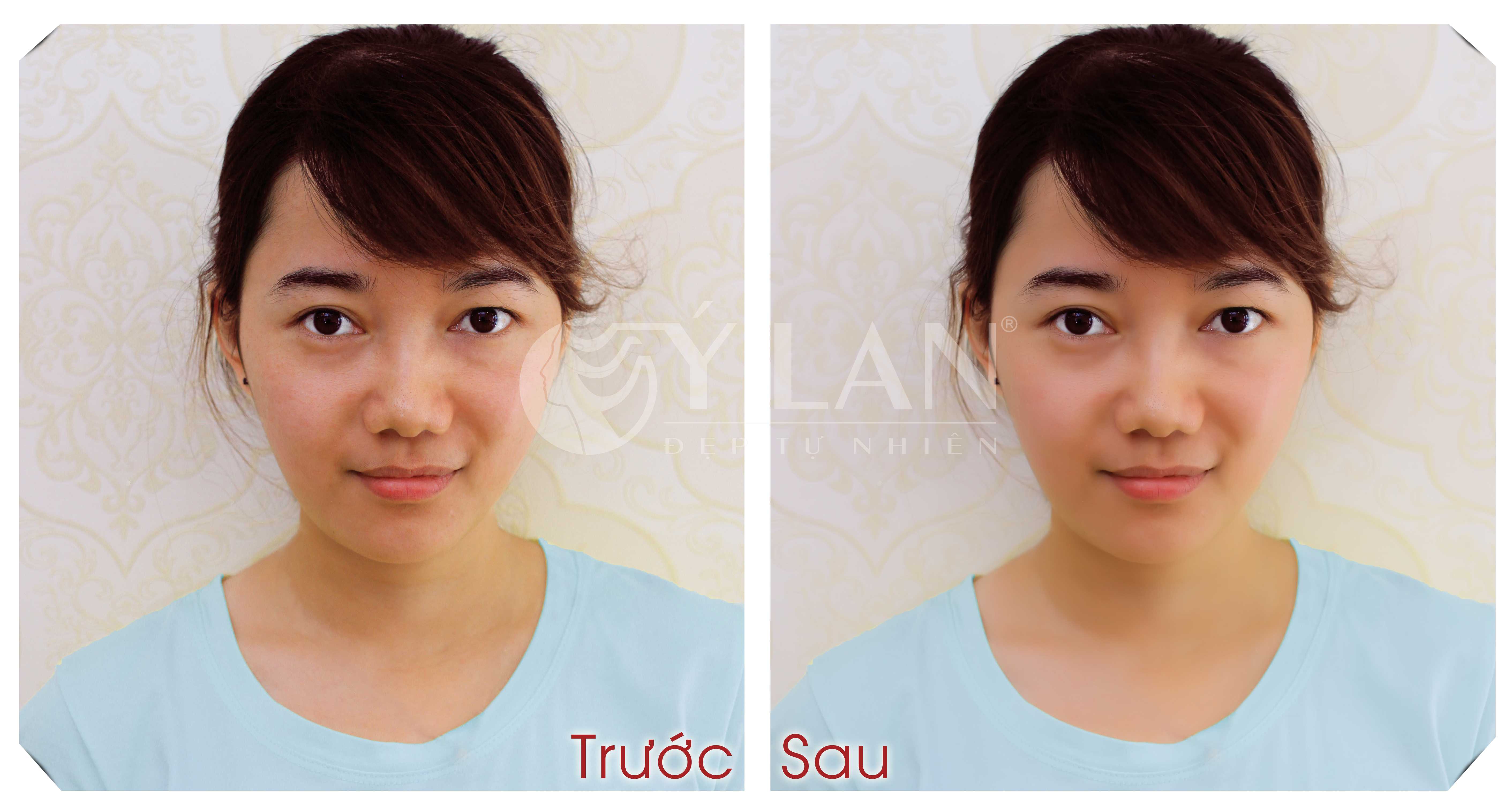 Triệt lông vĩnh viễn ria mép