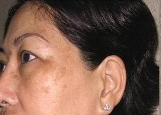 trị nám da ở đâu hiệu quả
