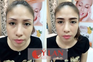 Xóa sửa lông mày