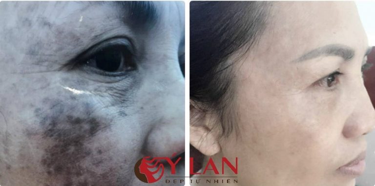 Ảnh 4. Da của chị Hiền đã sạch hết nám sau khi điều trị tại thẩm mỹ viện Ý Lan