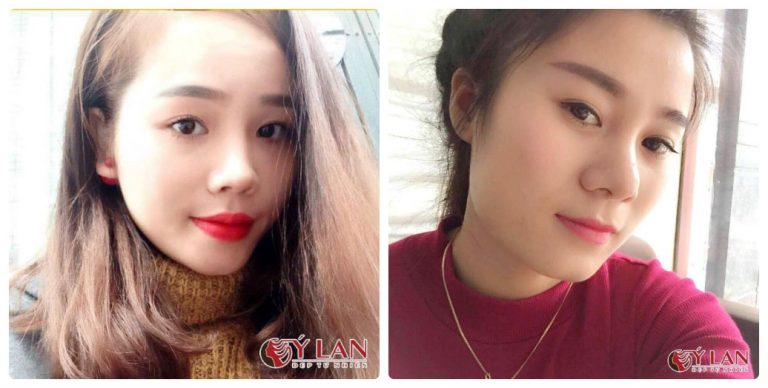 phun-phu-sap-long-may-cong-nghe-doc-quyen-tai-tham-my-vien-y-lan-1