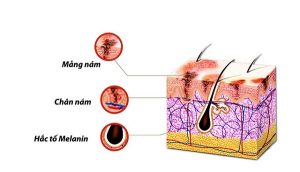 nam-da-la-hoi-chung-roi-loan-sac-to-melanin-1