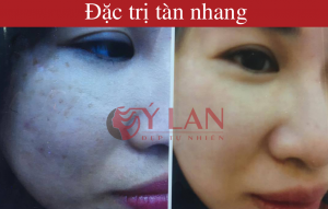khac-hang-dieu-tri-tan-nhang-thanh-cong-tai-y-lan