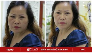 tre-hoa-da-hifu