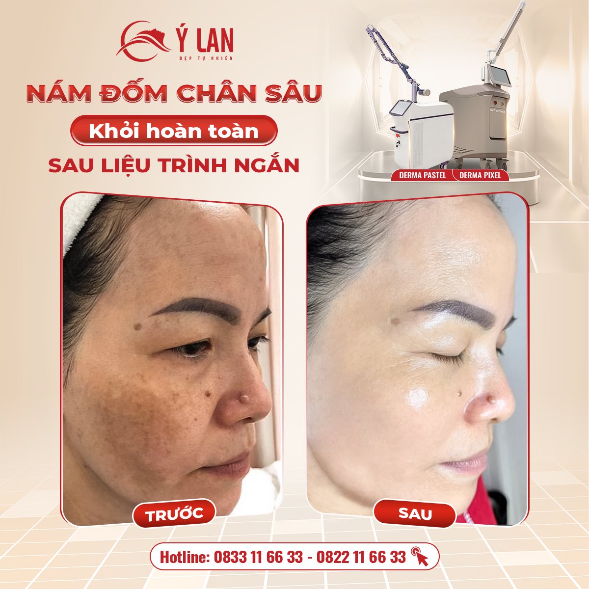 Hàng ngàn phụ nữ đã khỏi nám khi đến với Ý Lan.