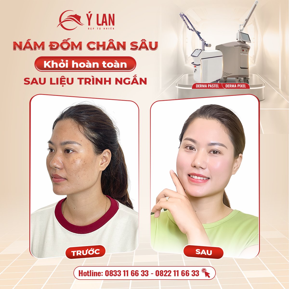 Trị nám chân sâu hiệu quả nếu đúng phác đồ