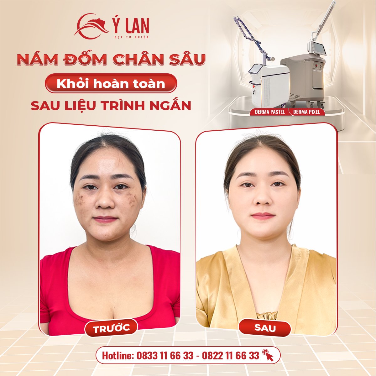 Hình ảnh khách hàng chữa nám thành công tại Ý Lan.