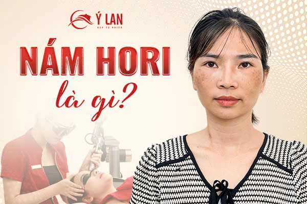 Nam_Hori_la_gi?_Dac_diem_va_benh_ly_lien_quan