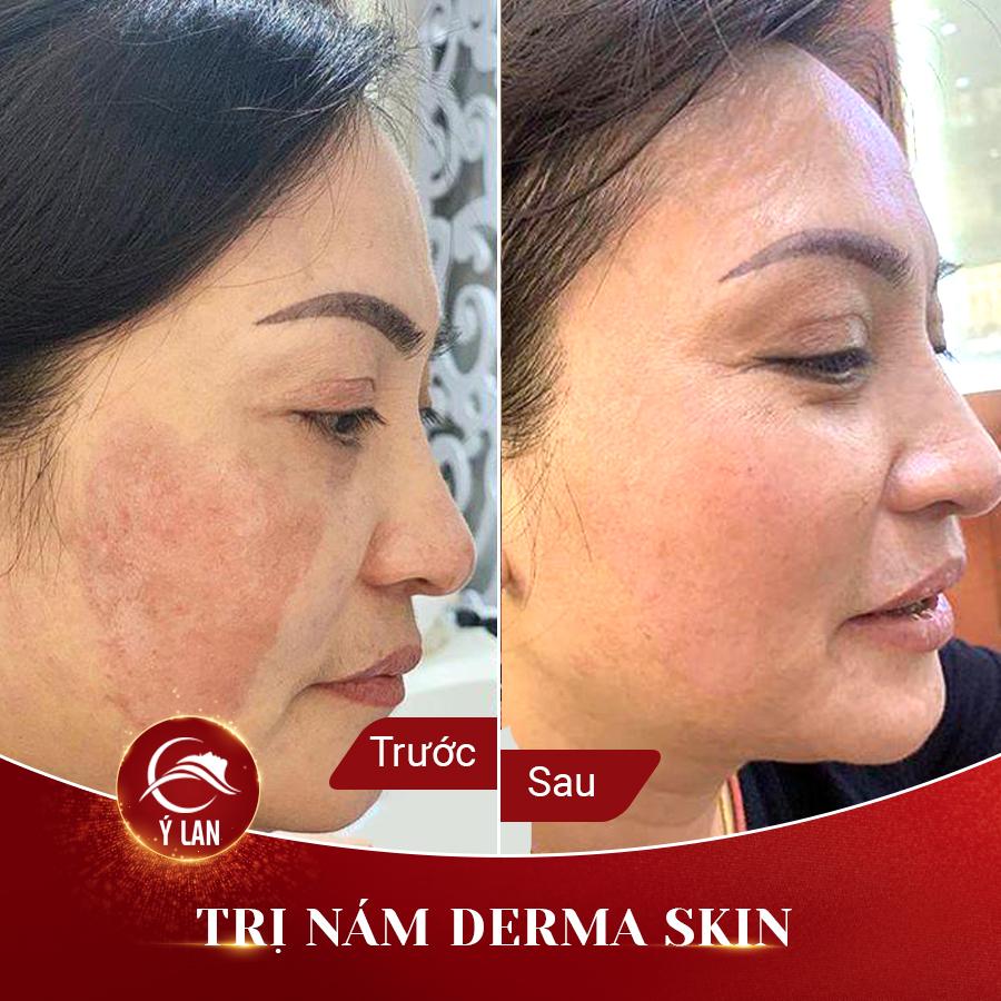 tri-nam-derma-skin