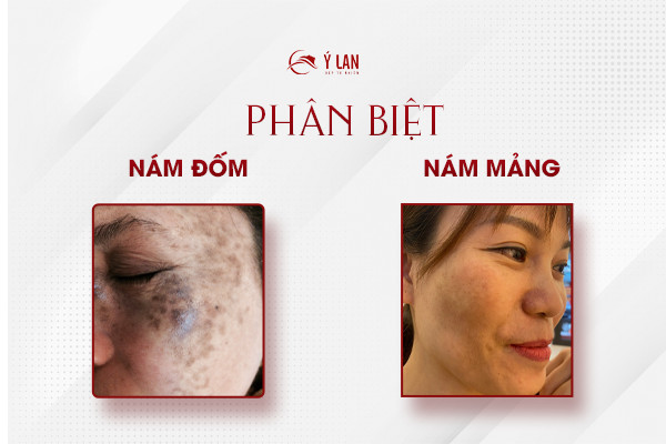 Phan_biet_nam_dom_va_nam_mang