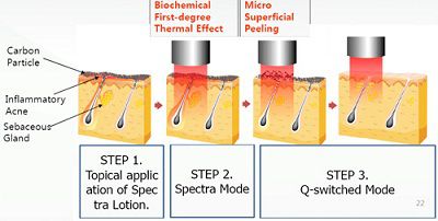 Trị mụn bằng phương pháp peel