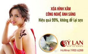xoa-hinh-xam-2