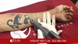 xoa-hinh-xam