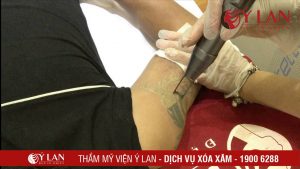 xoa-hinh-xam